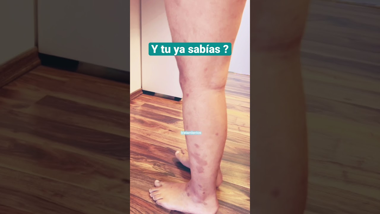 porque me salen manchas rojas en las piernas