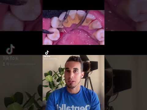 de que esta hecho el sarro delos dientes