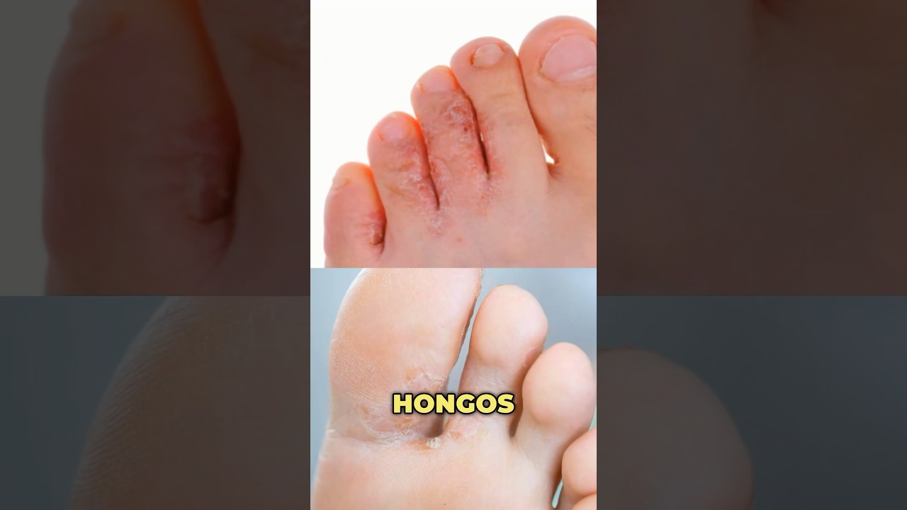 tipos de hongos en la planta del pie