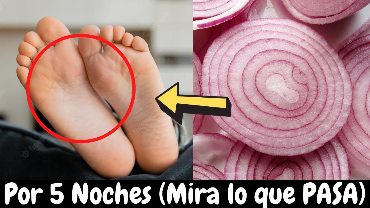 cebolla en los pies para bajar la fiebre